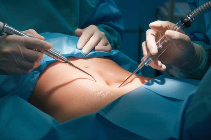 Advanced Laparoscopic Surgery