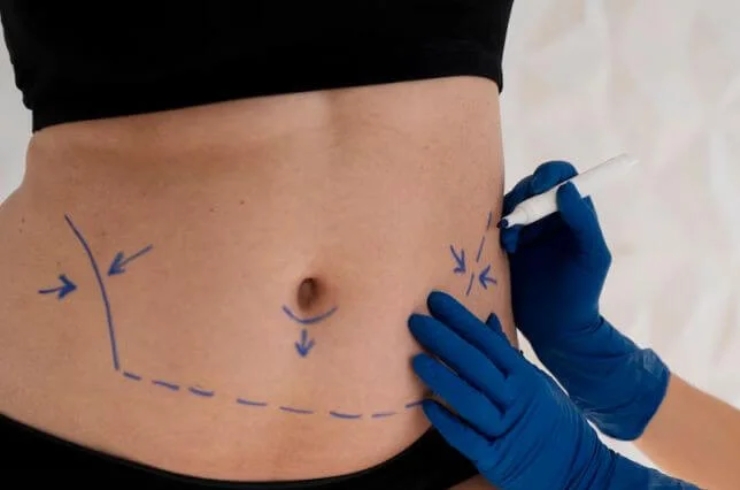 Bariatric Surgery