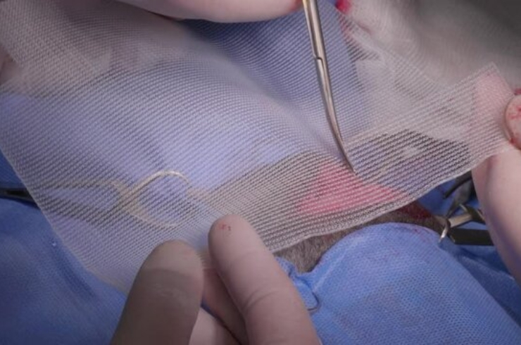 Hernia Repairs