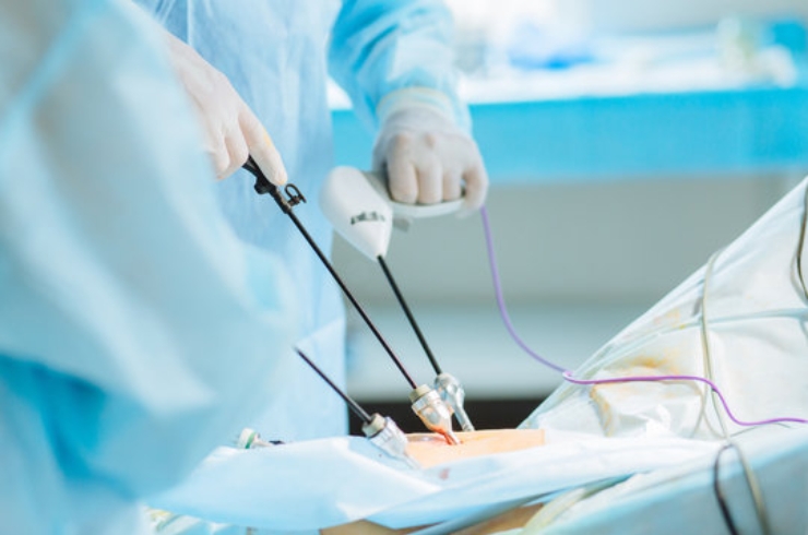 Laparoscopic Fundoplication (Anti-Reflux Surgery)