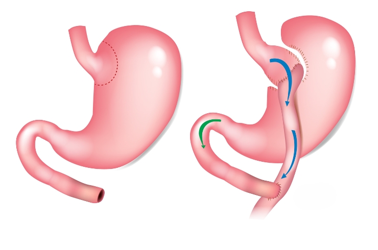 Roux-en-Y Gastric Bypass