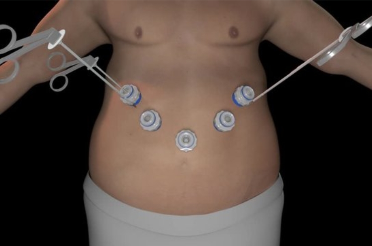 Sleeve Gastrectomy