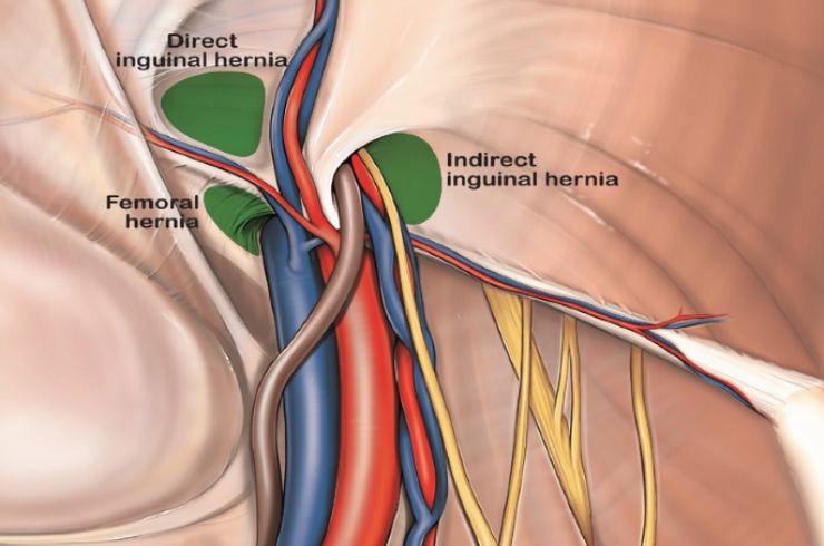 TAPP (Transabdominal Preperitoneal Repair)